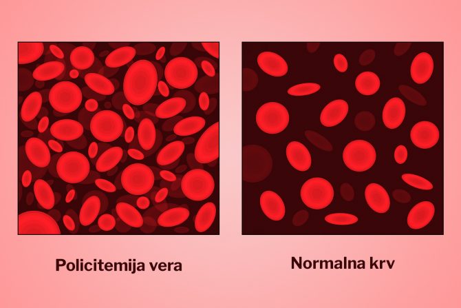 policitemija vera bolest