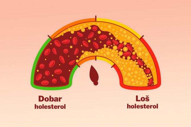 simptom visokog holesterola