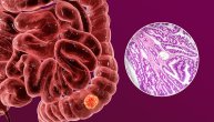 Adenokarcinom je najčešći tip raka koji može da zahvati bilo koji organ