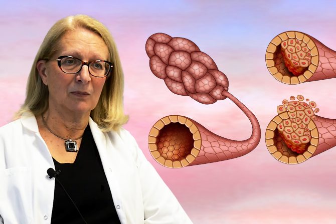 In situ karcinom dojke dr Zorka Milovanović