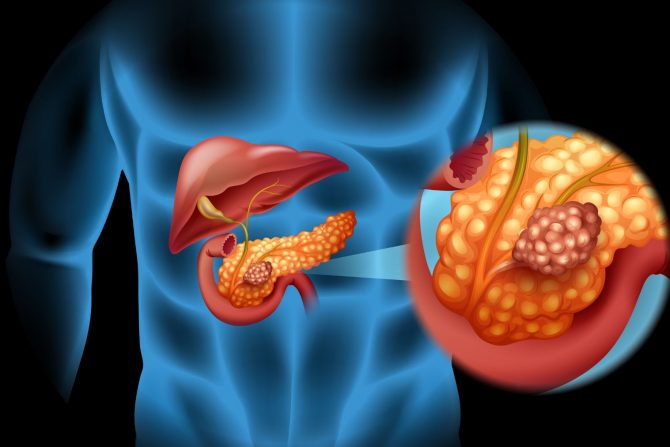 Rak pankreasa i dijabetes