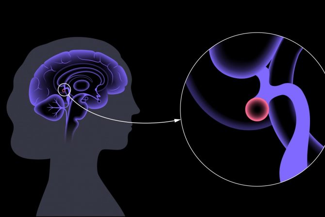 neuroendoktrini tumori