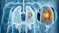 Šta znači „neoperabilni rak pluća“ i kakvi su rezultati novih terapija