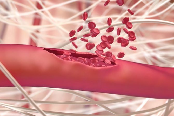 unutrašnje krvarenje