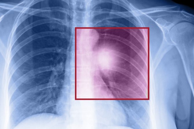 Mitovi i zablude o raku