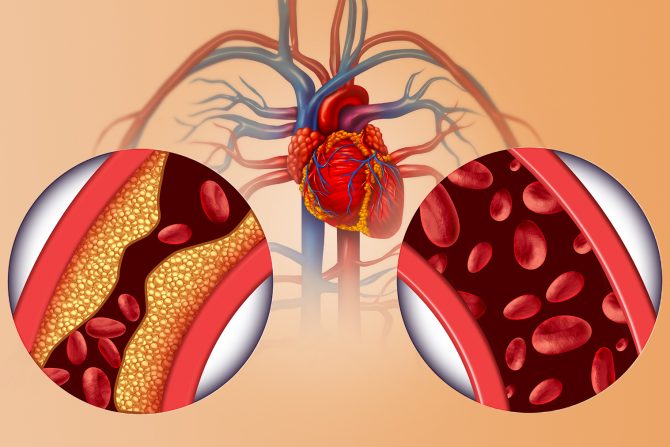 visok krvni pritisak