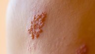 Herpes zoster izaziva veći dugoročni rizik od srčanog i moždanog udara, utvrdili naučnici