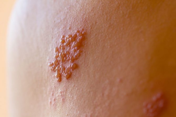 herpes zoster