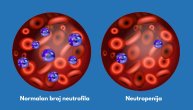 Na šta upozoravaju visoki ili niski neutrofili u krvi i šta je neutropenija