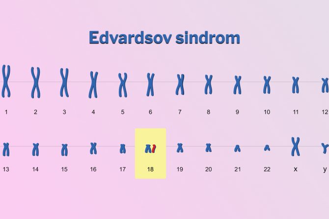 Edvardsov sindrom