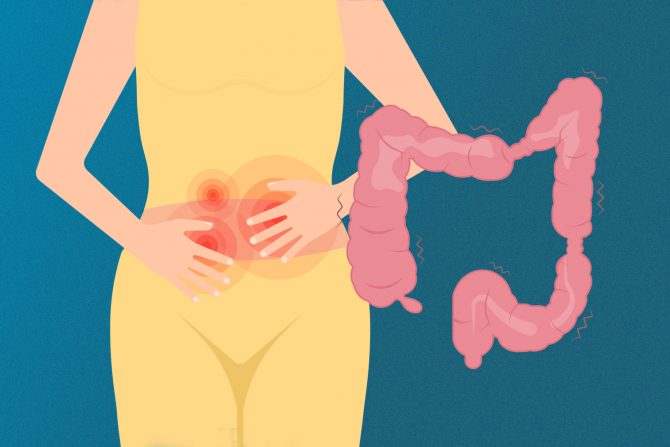 Sindrom iritabilnog creva