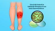 Crveni vetar je bakterijska infekcija kože koja bi mogla da se proširi i na srčane zalistke