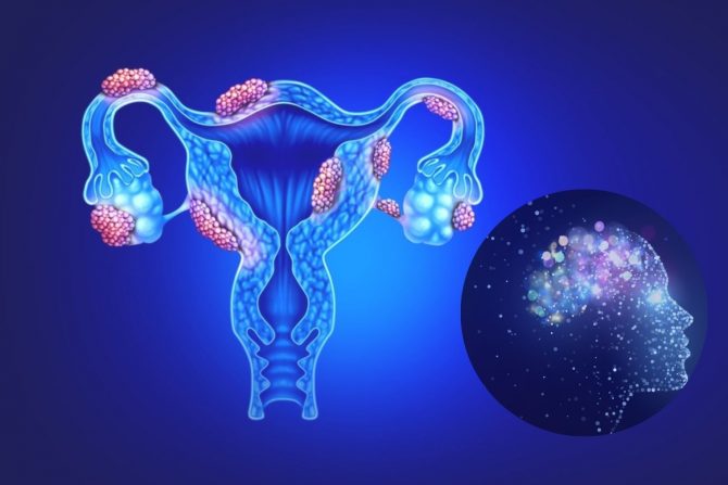 žene sa endometriozom