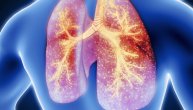 Obostrana upala pluća nekada zahteva i dodatni kiseonik