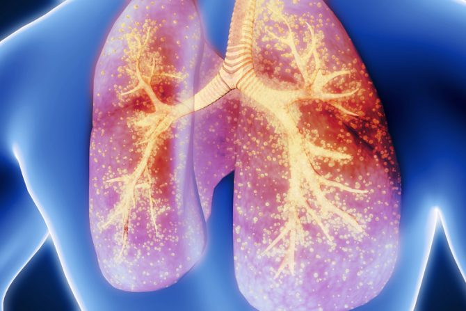 obostrana upala pluća