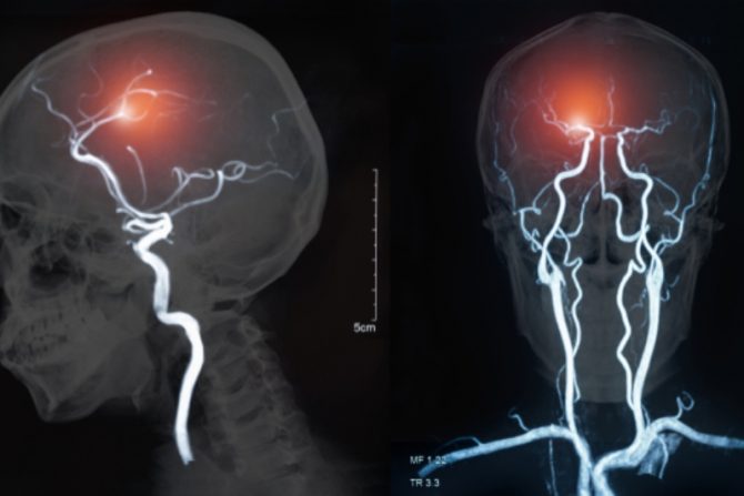 Rizik od moždanog udara