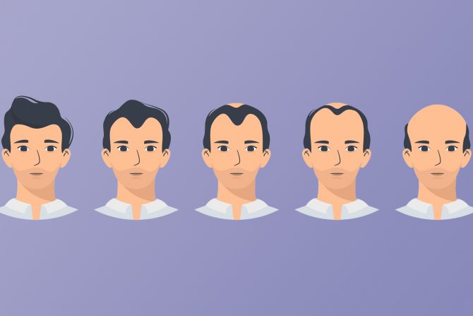 gubitak kose kod muškaraca