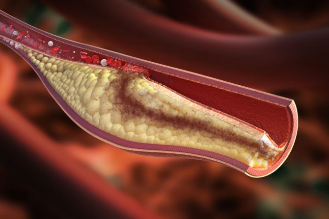 Kardiovaskularne bolesti