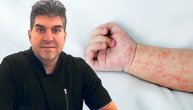 Do kakvih komplikacija može doći ako nevakcinisano dete dobije male boginje