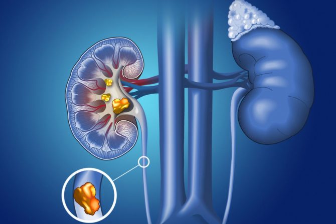 kamen u bubregu