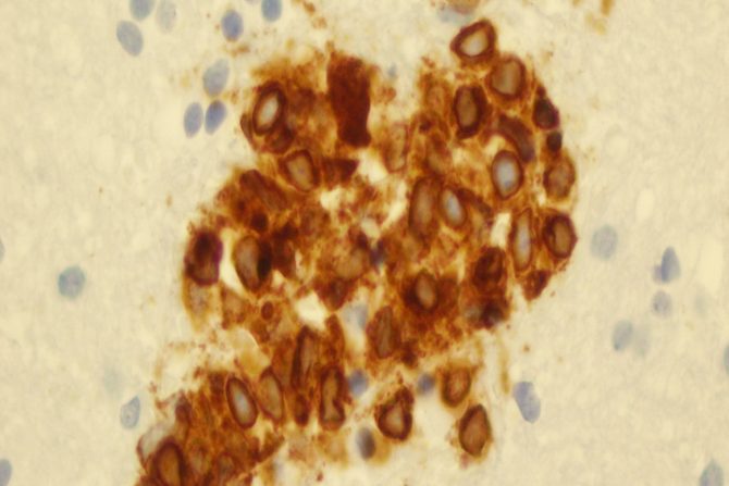 non Hočkinov limfom