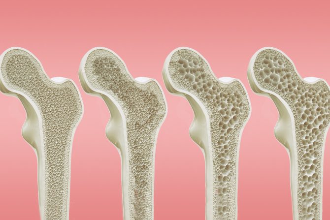 osteoporoza