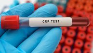 Zašto se radi CRP test i šta ova analiza može da otkrije