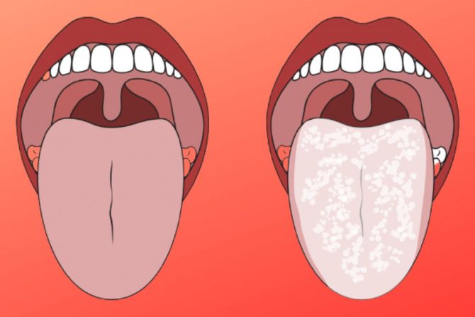 bele naslage na jeziku