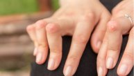 Kako se leče reumatoidni čvorovi i šta povećava rizik od formiranja kvržica