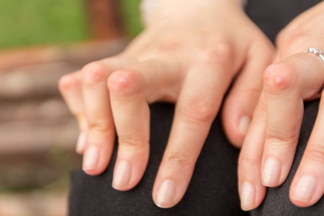 Reumatoidni čvorovi