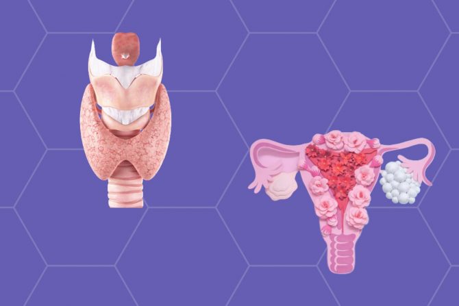 Sindrom policističnih jajnika i poremećaj štitne žlezde