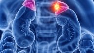 Na tumor nadbubrežne žlezde najčešće upozorava visok krvni pritisak ali i neki uobičajeni simptomi