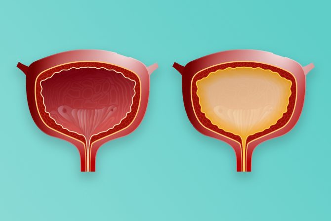 zadržavanje mokraće