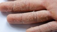 Zašto se koža ljušti i kako se leči ovaj dermatološki problem