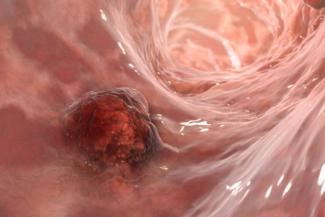 fleksibilna sigmoidoskopija