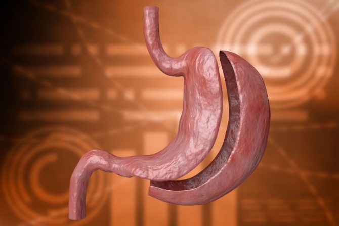 Barijatrijska hirurgija