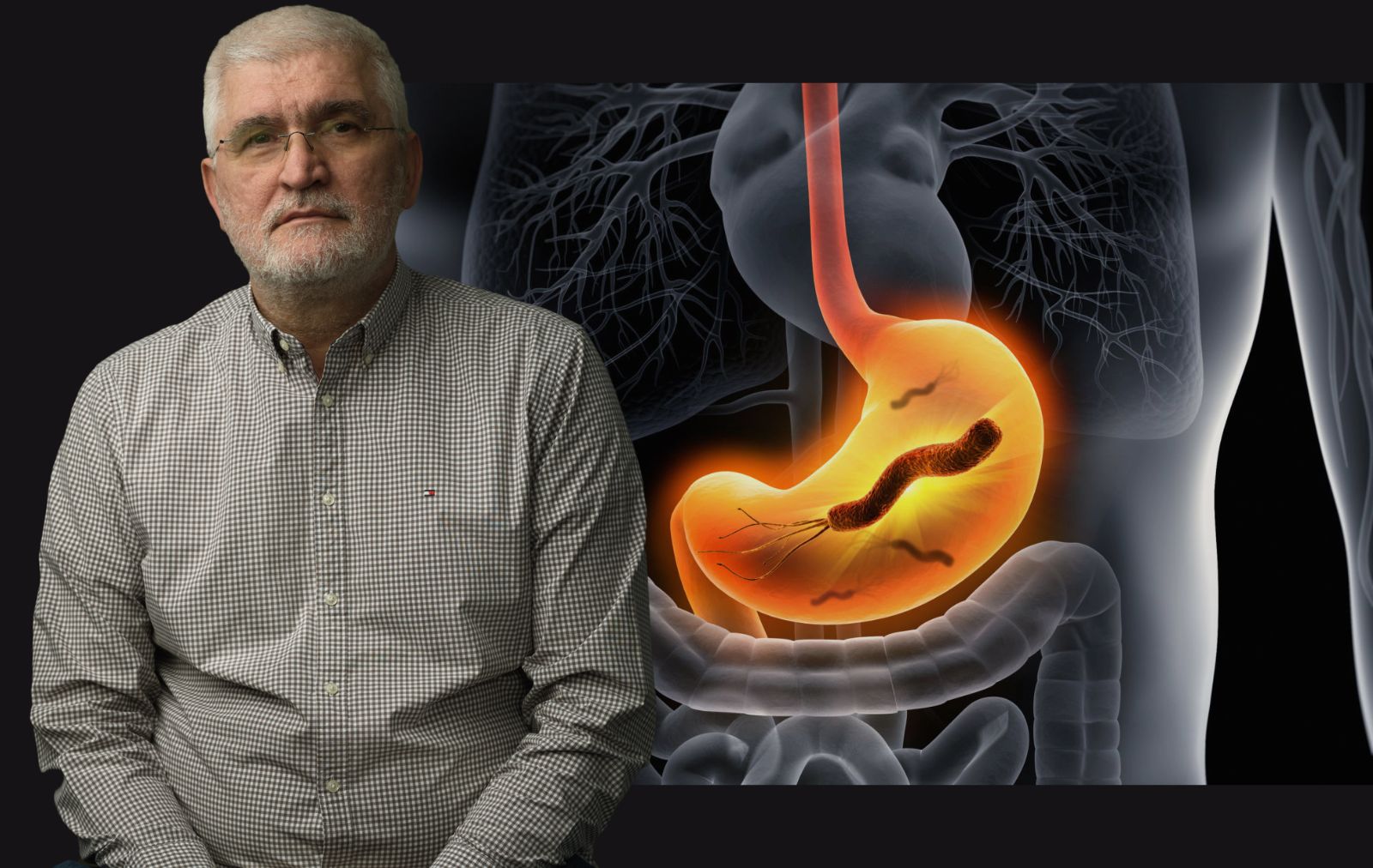 Neleena heliko bakterija ne izaziva samo gastritis i ir, ve i redak  oblik limfoma - eKlinika