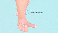 Neurofibrom – kako da prepoznamo ovaj redak tip tumora