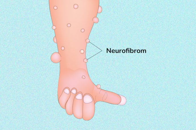 Neurofibrom