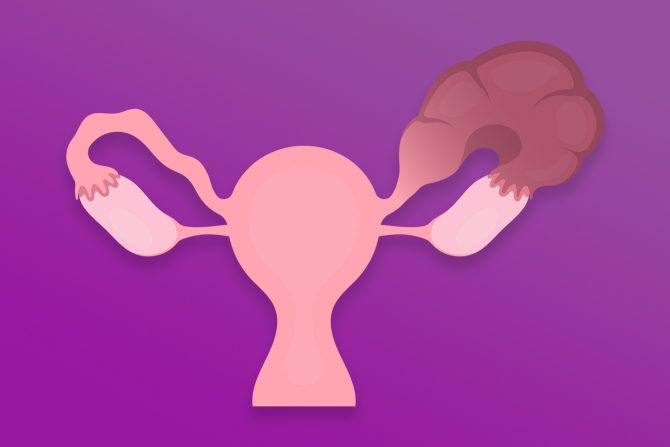 Paraovarijalne ciste