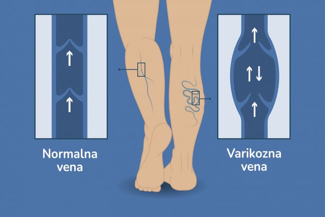 površinska upala vena