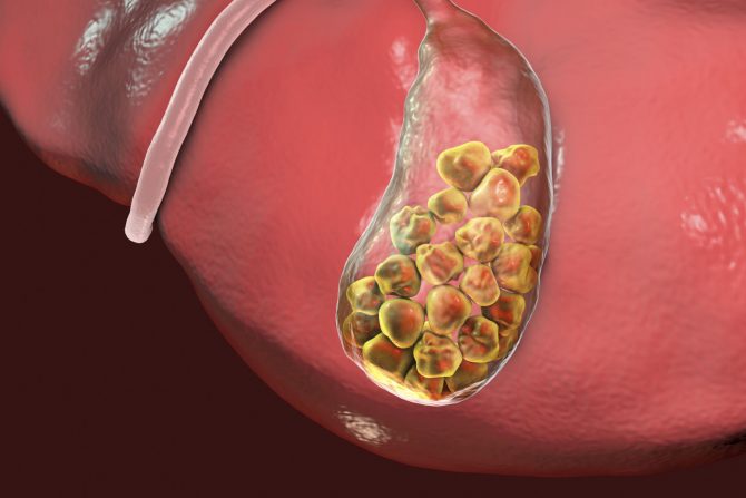 akutna upala žučne kese