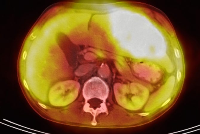 metastatski rak jetre