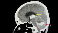 Šta izaziva hidrocefalus i zašto može biti opasniji za odrasle nego za decu