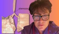 Urođeno suženje traheje ugrožava disanje, operacija niske stenoze prvi put urađena kod nas