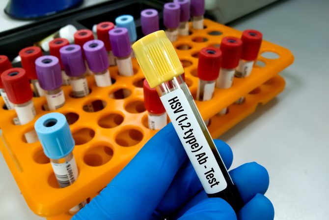 virus herpes simpleks