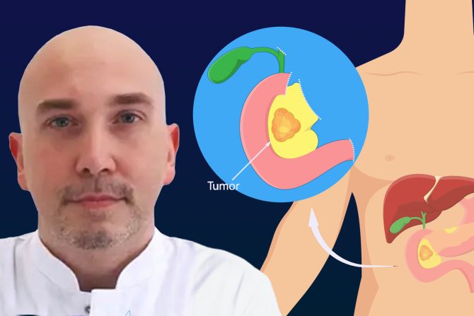 rak pankreasa operacija