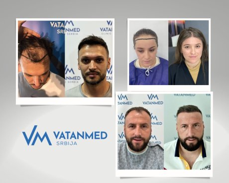 Transplantacija kose