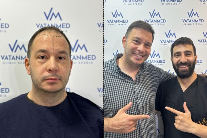 transplantacija kose