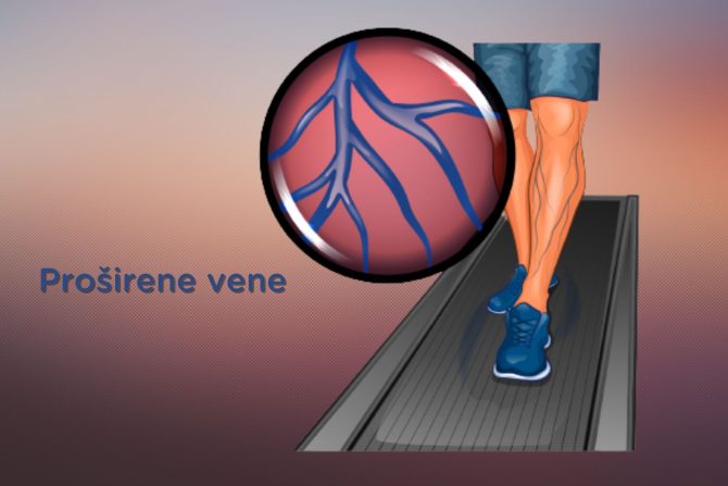 proširene vene i vežbanje